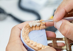 A 3D illustration of a traditional dental bridge