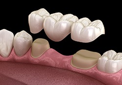 A 3D illustration of an implant dental bridge