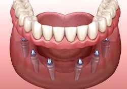 A digital image of 6 dental implants being used to secure a denture into place on the lower arch of the mouth
