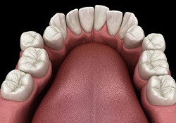 Illustration of crooked teeth