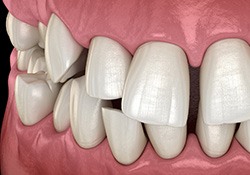 Illustration of gapped teeth