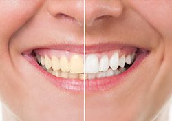 Closeup of teeth half before and half after teeth whitening