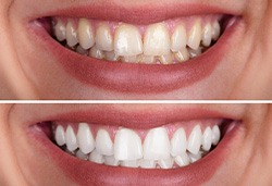 Person’s smile before and after teeth whitening treatment
