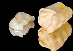Model of tooth and onlay restoration