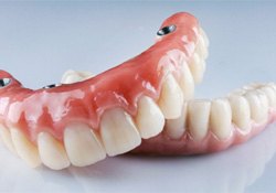 Example mockups of implant dentures