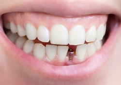 A dental implant in a person’s mouth