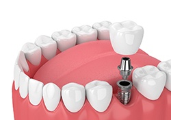 3D graphic of dental implant 