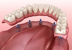 Illustration of implant dentures in Harrisonburg, VA