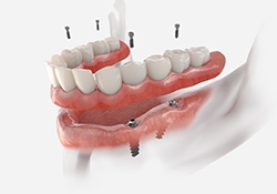 Render of implant dentures in Harrisonburg, VA being placed