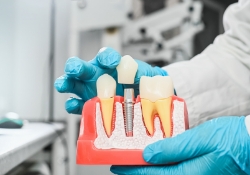 A dentist wearing sterile gloves holds an anatomical model with dental implants