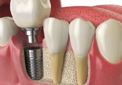 a digital illustration showing an implant crown