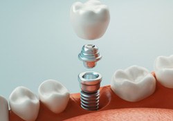 a digital illustration showing an implant crown