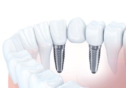 a digital illustration of an implant bridge