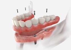 a digital illustration of an implant denture