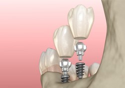 a digital illustration of mini dental implants