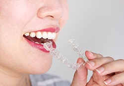 Woman taking out her Invisalign in Harrisonburg aligner 