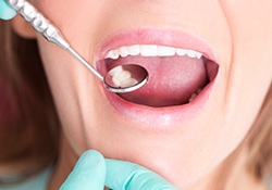 Lady getting teeth examined with dental mirror