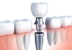 Animation of implant supported dental crowns