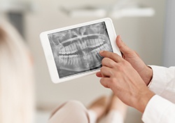 Panoramic dental x-rays