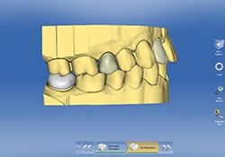 CEREC teeth model construction