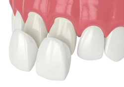Illustration of veneers being placed on front teeth
