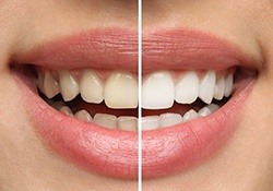 closeup before and after photos of a woman’s smile