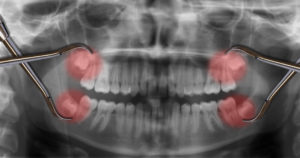 wisdom teeth x-ray