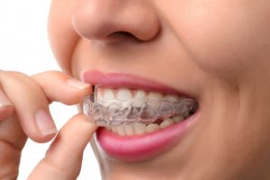 A woman removing her clear aligners.