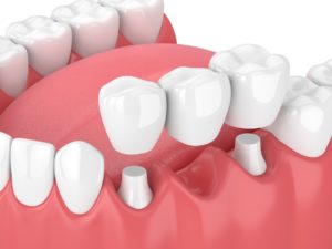 3D digital image of a dental bridge on the lower back teeth