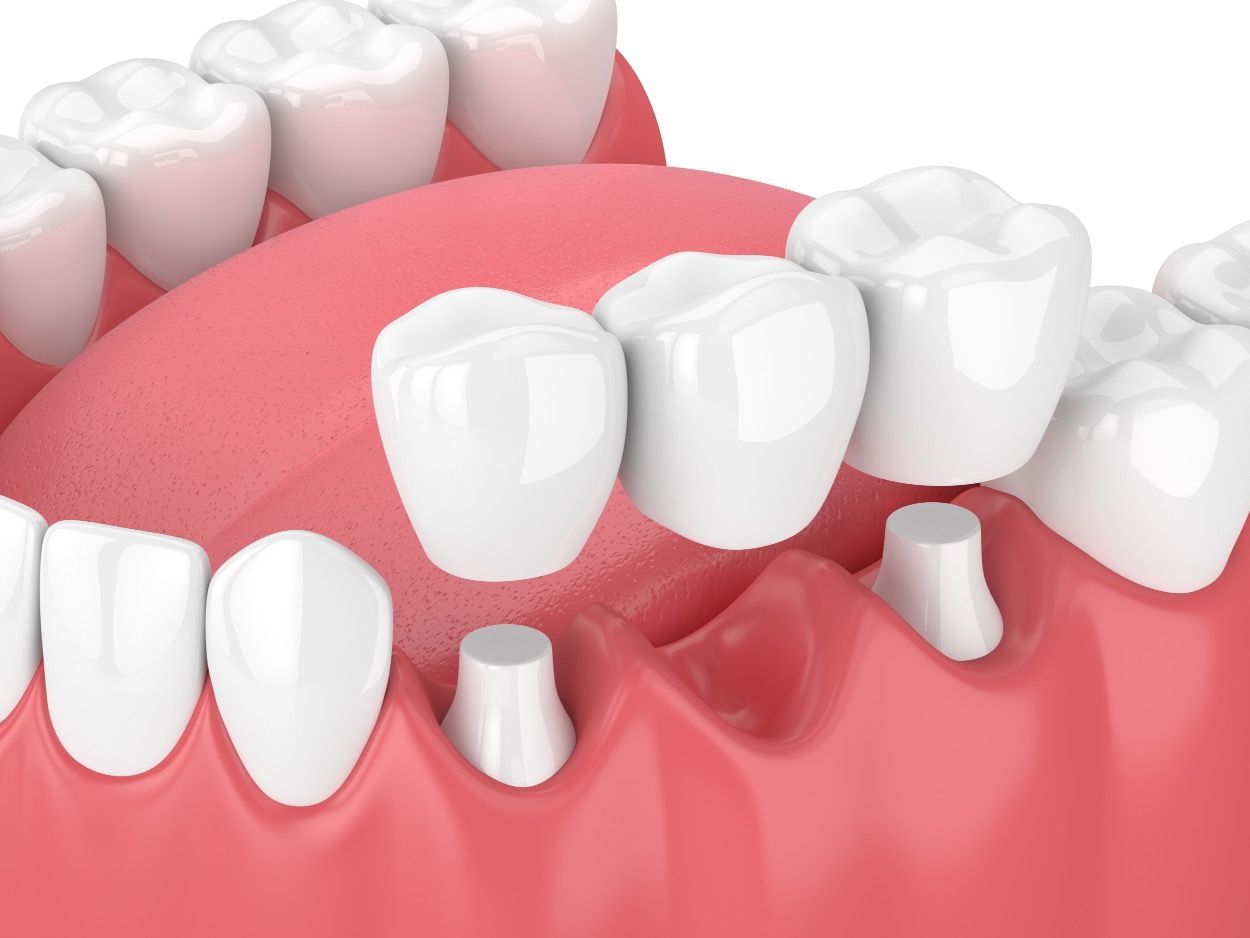 Ask a Dentist: Can the Teeth That Support a Dental Bridge Get Cavities?