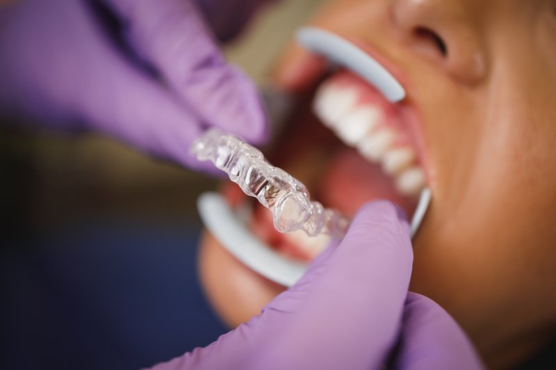 dentist placing Invisalign aligner on patient