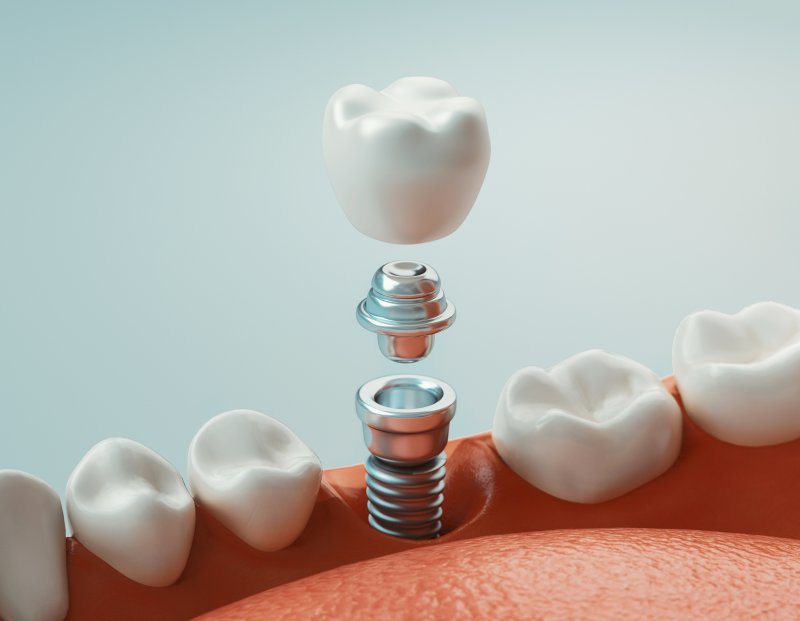 3D model of a dental implant