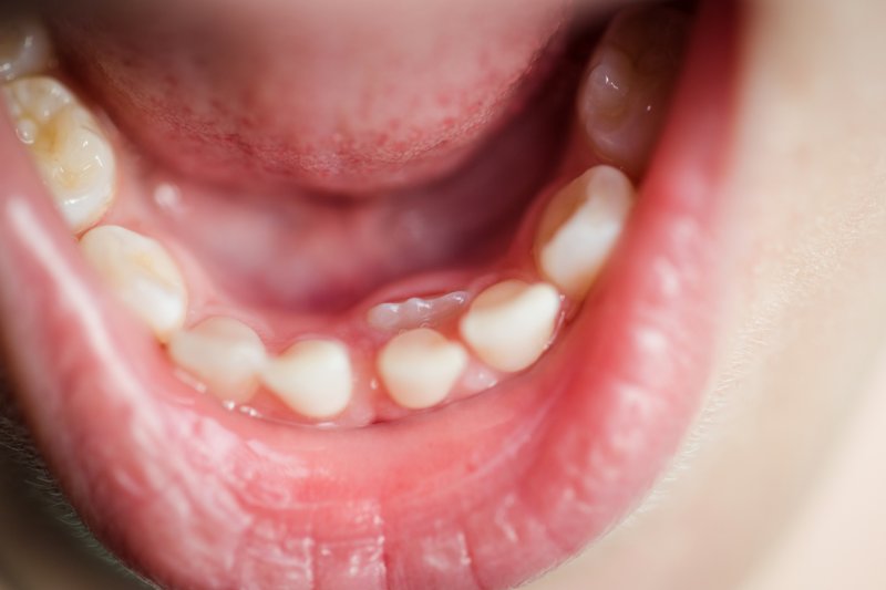 A child's bottom row of teeth with an extra tooth behind the bottom front teeth