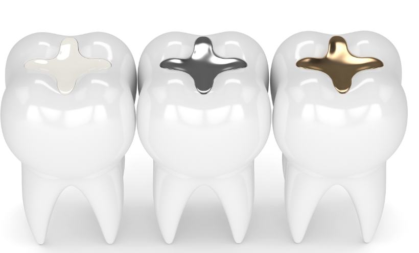 3D image of teeth with different fillings
