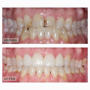 Close-up before and after of Charlie's teeth