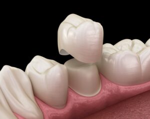Rendering of crown fitting on to tooth. 