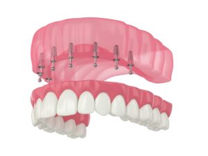 Digital rendering of implant dentures (top arch).